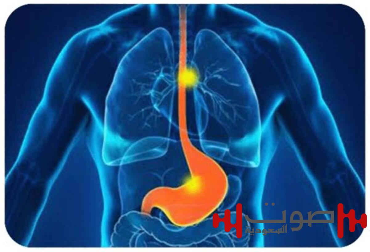 علماء يطورون كبسولة للكشف المبكر عن سرطان المريء