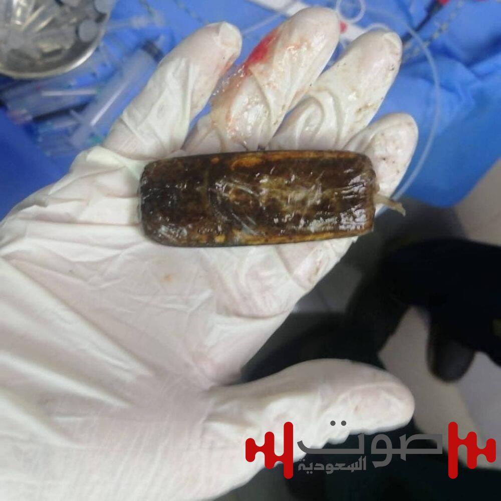 في واقعة نادرة.. استخراج هاتف محمول من بطن شاب مصري بعد عامين من ابتلاعه