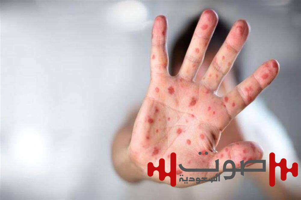 «الحصبة» تثير مخاوف الأمريكيين.. وتحركات واسعة للحد من المرض