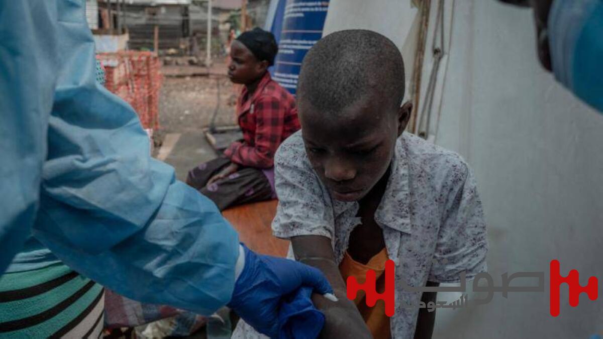 غينيا: ارتفاع حالات الإصابة بجدري القردة