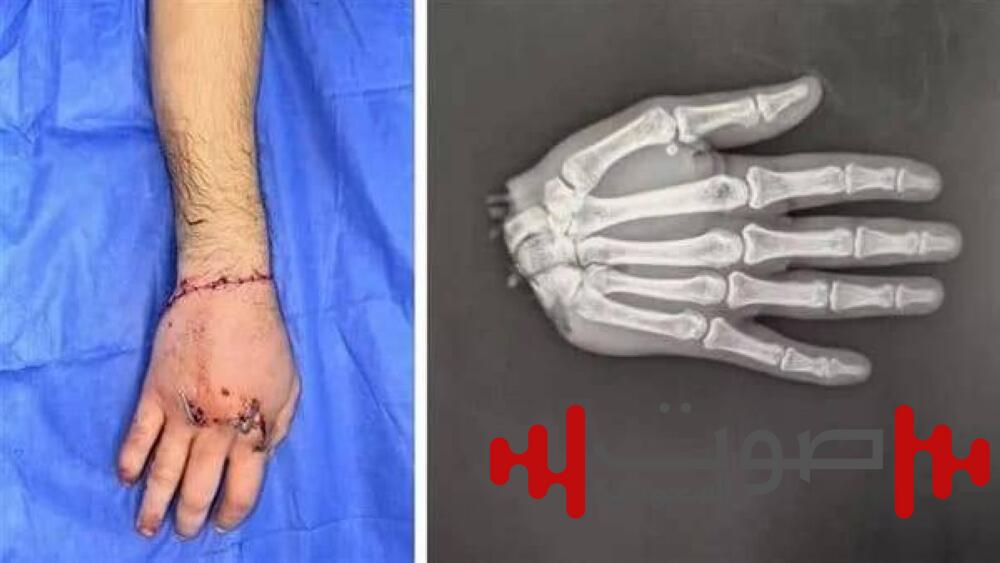 مصر: أطباء يعيدون يد شاب مبتورة