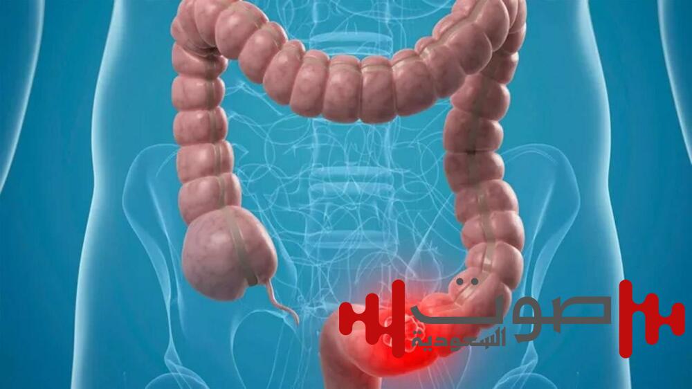 إستراتيجية جديدة لمكافحة سرطان القولون
