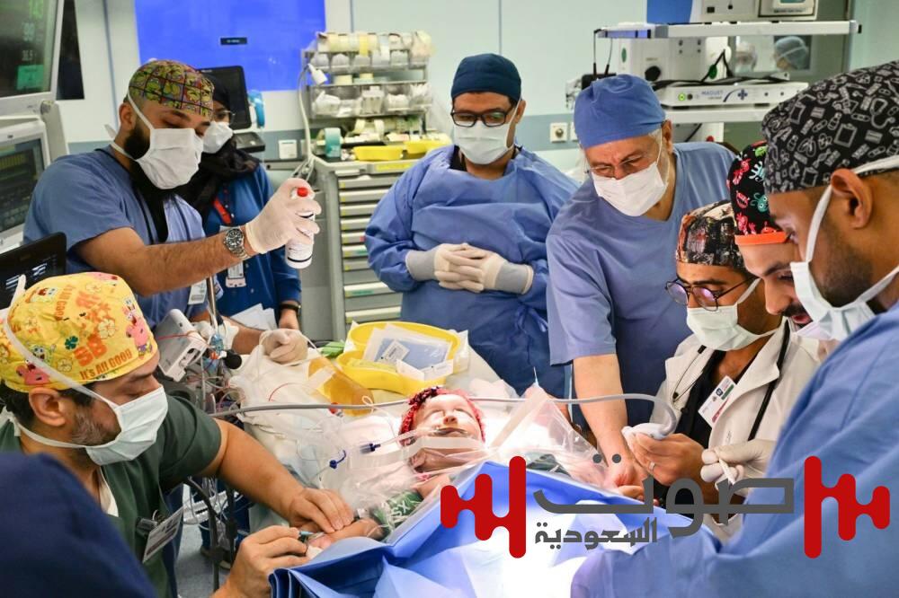 بدء عملية فصل التوأم الملتصق السعودي «يارا ولارا»